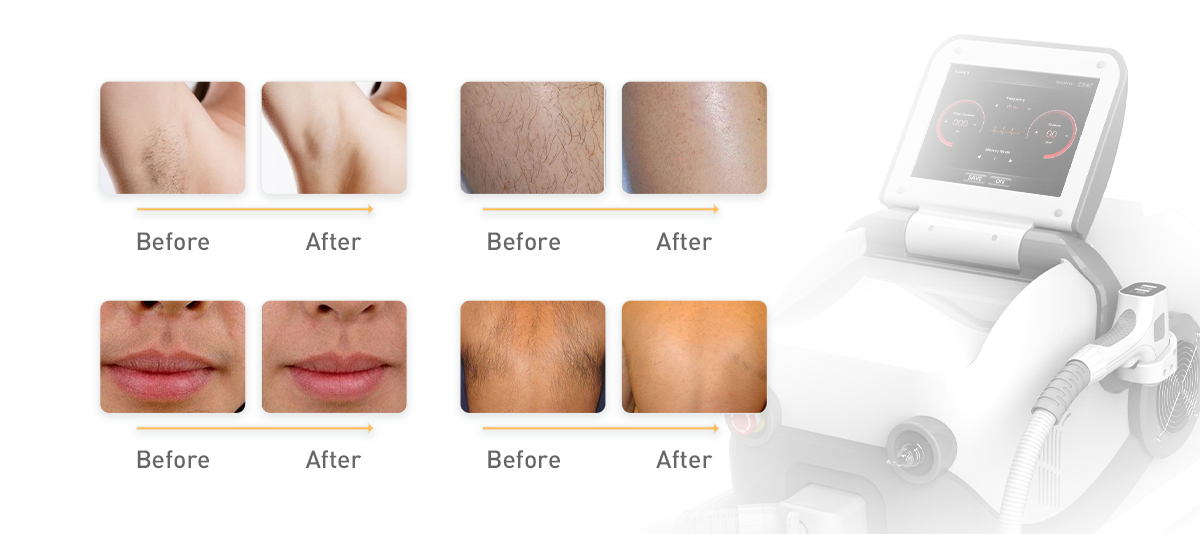 Portable 808NM Diode Laser Hair Removal System