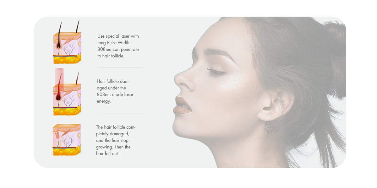 Portable 808NM Diode Laser Hair Removal System